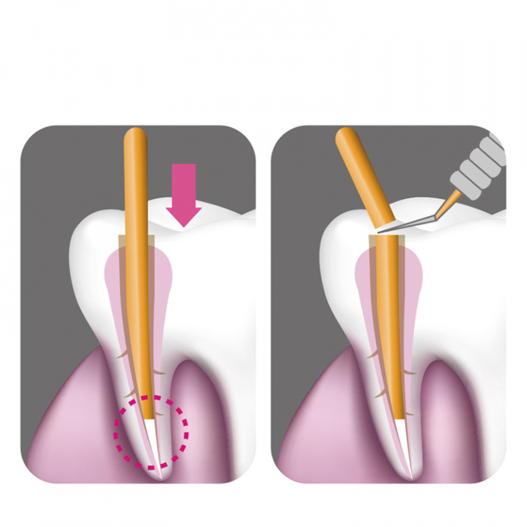 Gutta Percha Cutter Endodontic Supplies Bdsi Dental Supplies Uk